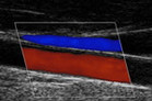 Duplexsonografie der Carotiden