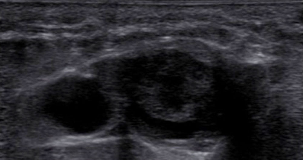 Venen-Diagnostik (Thrombose)